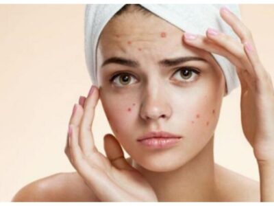 Da Mụn Có Nên Tẩy Tế Bào Chết Không? 1 Số Lưu Ý Cần Biết